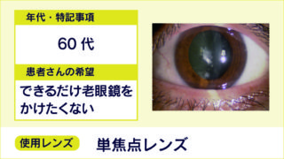 【白内障手術 症例2】60代/単焦点レンズ