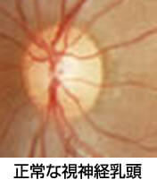 正常な視神経乳頭