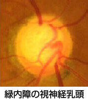 緑内障の視神経乳頭